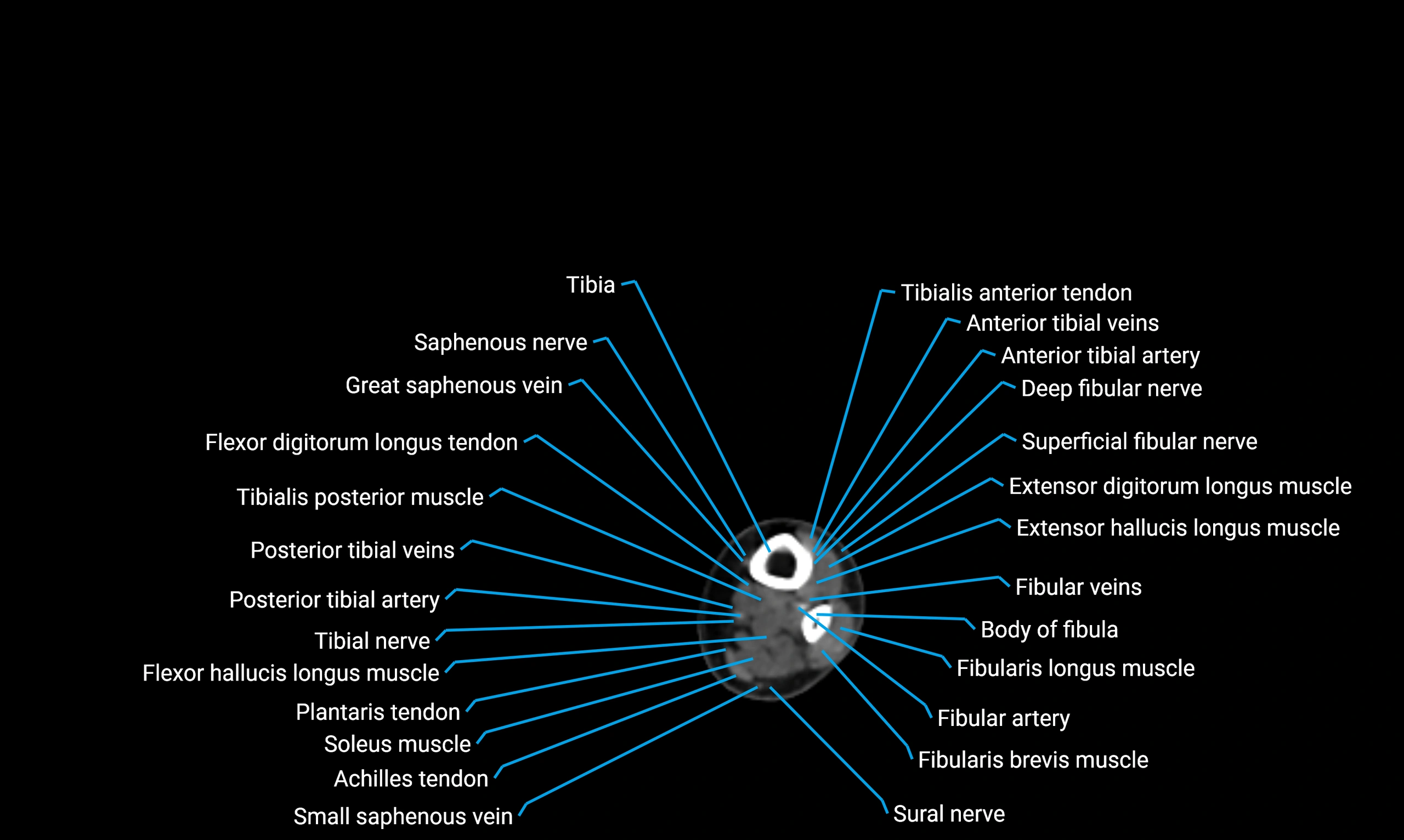 CT lower limb axial cross sectional anatomy labelled image 151 (2).webp